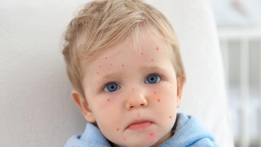 How To Get Rid Of Chicken Pox And Every Thing About Chickenpox
