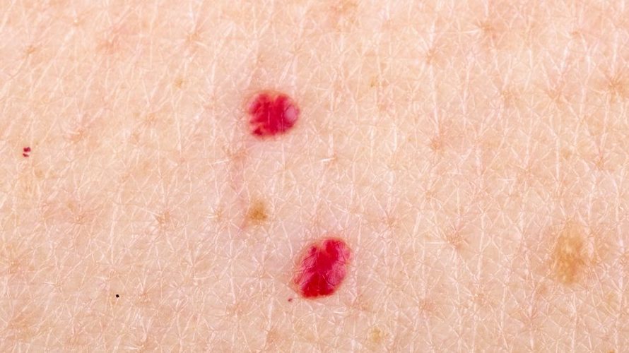 Cherry Angioma Removal At Home: Causes, Symptoms, and Treatments
