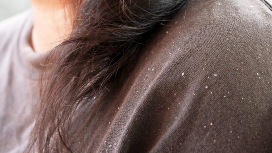How Long Does It Take To Get Rid Of Dandruff?