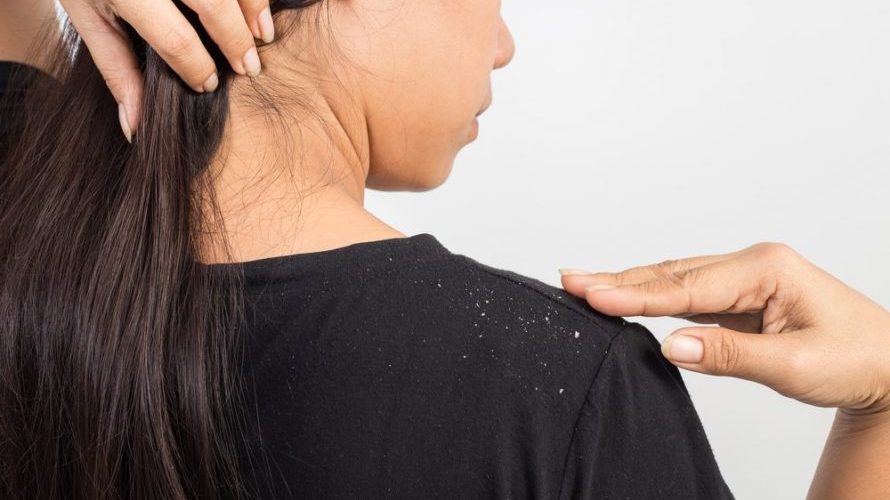 How to Get Rid of Dandruff without Washing Hair