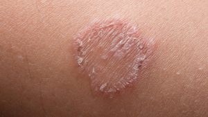 How To Get Rid Of Ringworm: Causes, Symptoms and Treatments