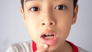 Blood Blister In Mouth: Causes, Symptoms, And Treatments