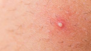 All Facts About Ingrown Hair Cyst: Symptoms, Causes, and Treatment