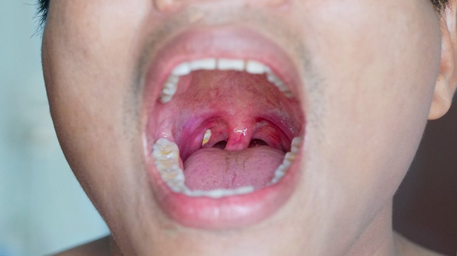 Can You Get Tonsil Stones Without Tonsils? What You Need To Know