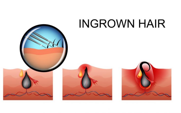 How ingrown hair is formed