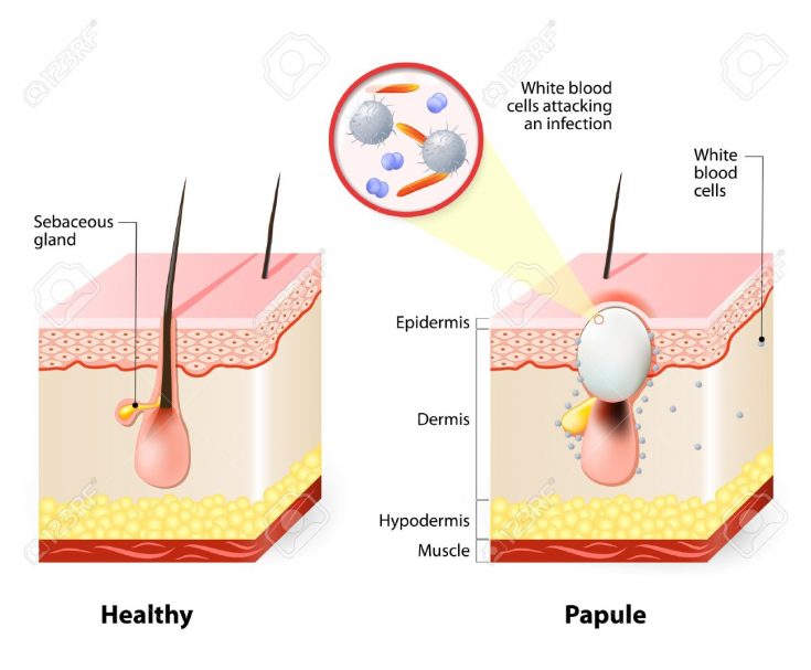 Blackheads are caused by too much oil secretion of your sebaceous glands.