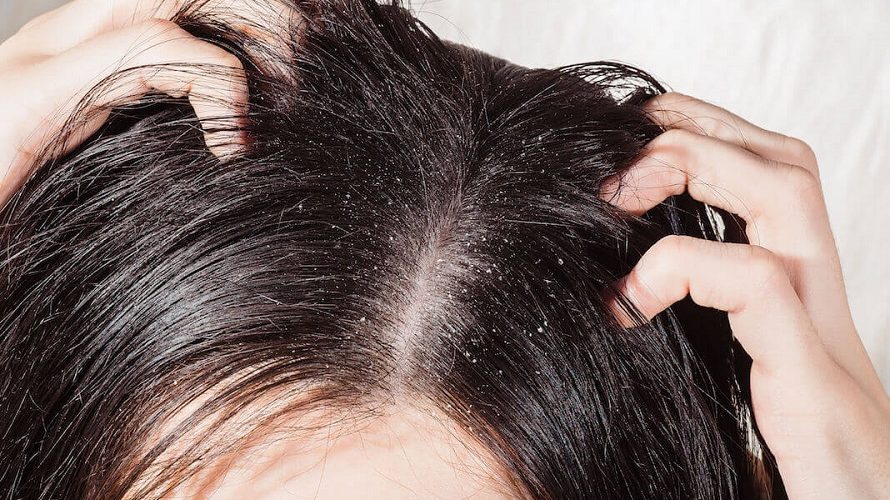 How To Prevent Dandruff? Good Tips To Use