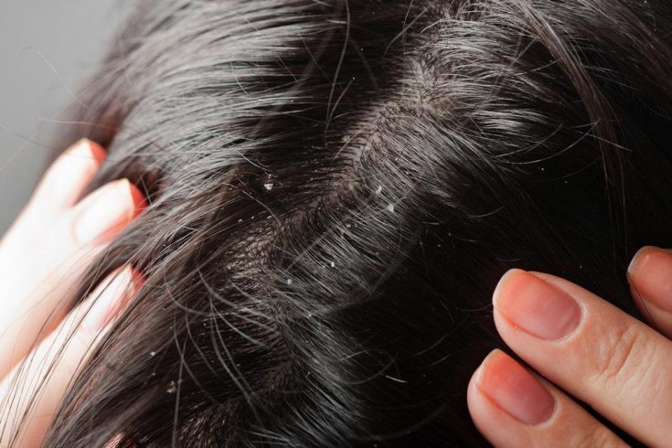 Dandruff is actually your dead skin coming off