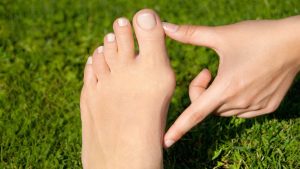 How To Get Rid Of A Bunion: Natural Remedies And Conventional Treatments