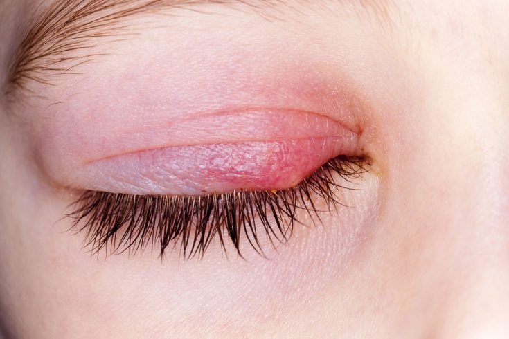 chalazion is a small bump on your eyelid