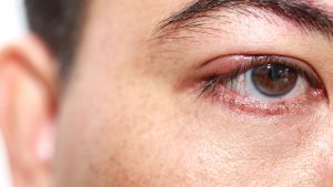 How To Get Rid of A Chalazion: Natural Remedies, Traditional Medicine, Prescribed Medications And Surgery