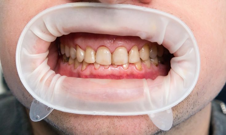 Calcium deposits on teeth
