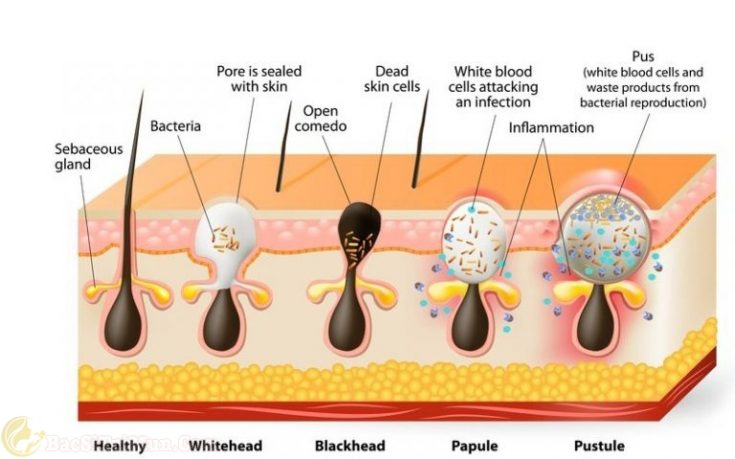Acne leads to excess oil production which causes blackheads to be black